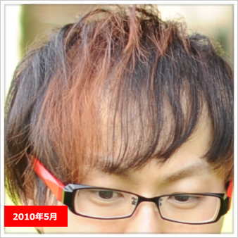【毛が生えた!!】東京皮膚科・形成外科の薄毛治療(AGA)が凄い1