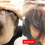 【AGA薄毛治療】ハゲが治るまでの経緯と現在の薄毛予防方法まとめ