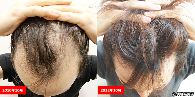 【毛が生えた!!】東京皮膚科・形成外科の薄毛治療(AGA)が凄い