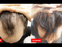 【AGA薄毛治療】ハゲが治るまでの経緯と現在の薄毛予防方法まとめ