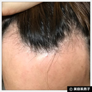 【AGA治療】ミノキシジル世界最高濃度『ポラリス』育毛【2ヶ月目】