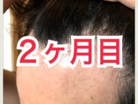 【AGA治療】ミノキシジル世界最高濃度『ポラリス』育毛【2ヶ月目】