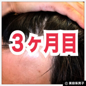 【AGA治療】ミノキシジル世界最高濃度『ポラリス』育毛【3ヶ月目】