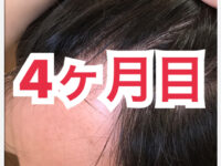 【AGA治療】ミノキシジル世界最高濃度『ポラリス』育毛【4ヶ月目】