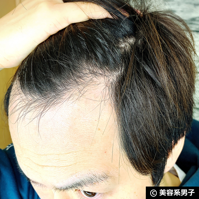 体験40日目 ミノキシジル世界最高濃度 フォリックスfr16 育毛効果