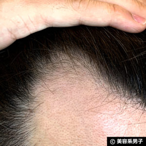 【体験40日目】ミノキシジル世界最高濃度[フォリックスFR16]育毛効果05