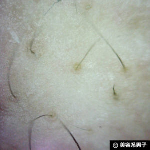 【体験40日目】ミノキシジル世界最高濃度[フォリックスFR16]育毛効果06