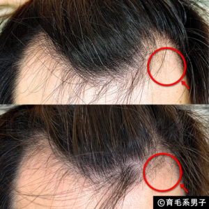 【体験60日目】ミノキシジル16％[フォリックス]育毛効果【写真あり】10