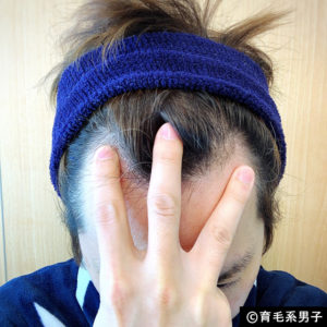【体験60日目】ミノキシジル16％[フォリックス]育毛効果【写真あり】14