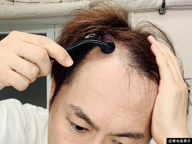 【AGA治療】世界No.1ミノキシジル育毛剤+頭皮ダーマローラー体験開始-07