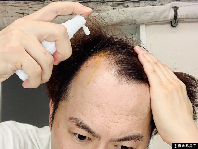 【AGA治療】世界No.1ミノキシジル育毛剤+頭皮ダーマローラー体験開始-08