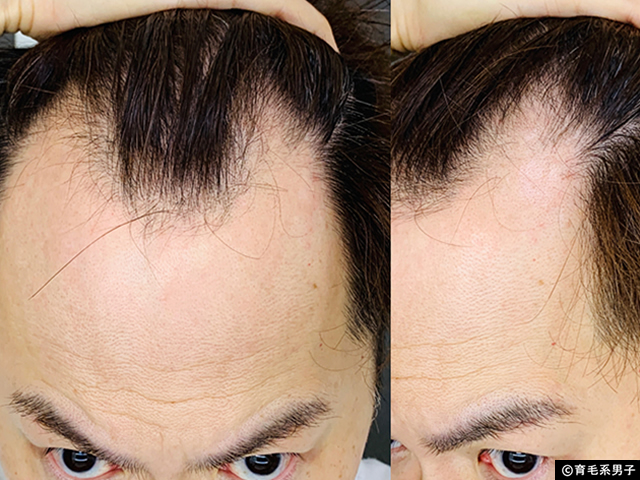 【AGA治療】世界No.1ミノキシジル育毛剤+頭皮ダーマローラー体験開始-10