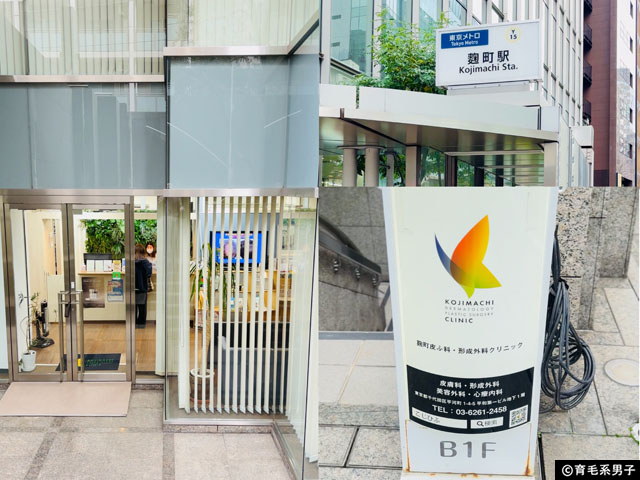 【AGA治療】幹細胞培養上清で発毛は変わる?麹町皮ふ科・形成外科クリニック体験【1回目レポート】-01