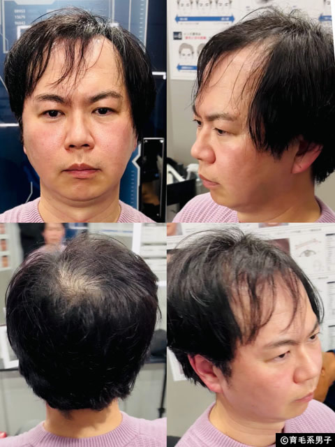 【CMで話題】イケメン製作所の”バレない”かつら「STL(ステルス)」を体験してみた結果-04